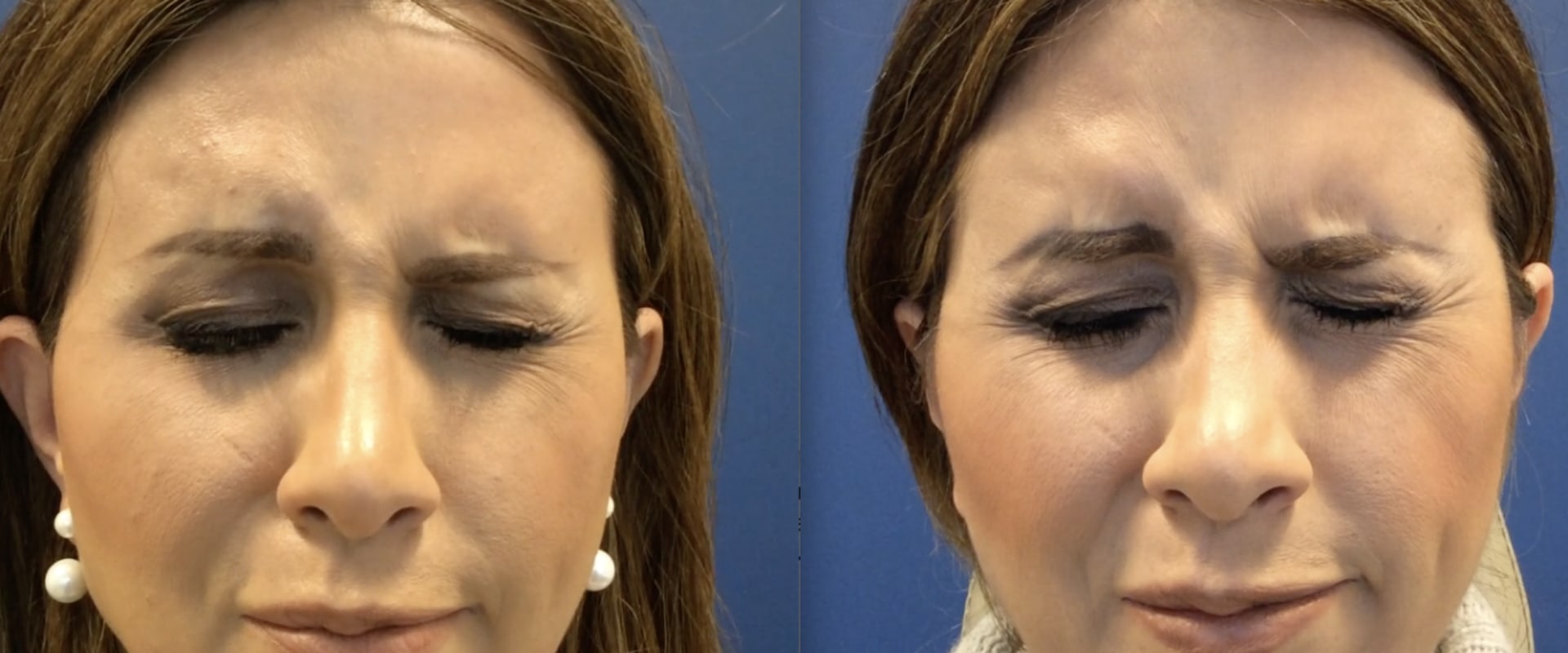 Can Facial Fillers Help Patients with Bell's Palsy?
