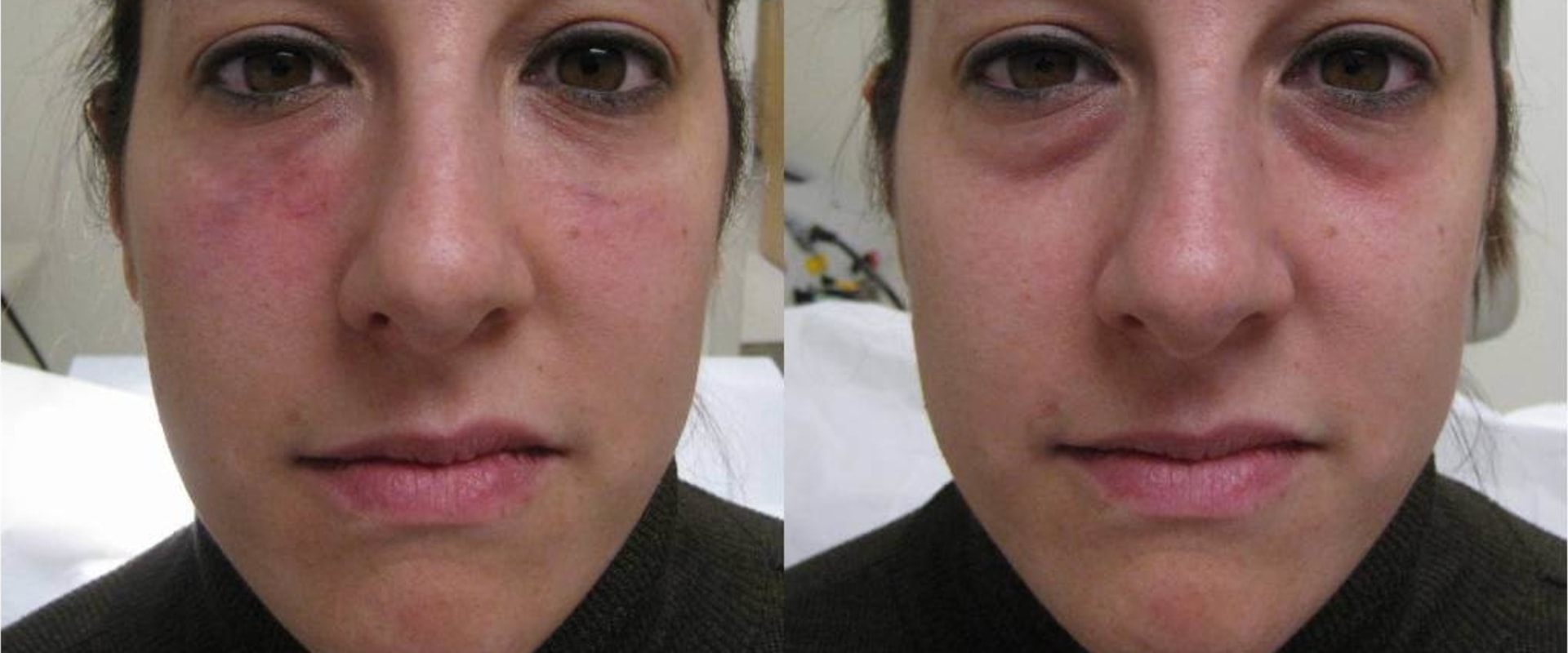 Are Facial Fillers Safe? A Comprehensive Guide