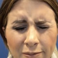 Can Facial Fillers Help Patients with Bell's Palsy?