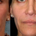 Which Facial Fillers are Permanent? A Comprehensive Guide