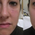 Are Facial Fillers Safe? A Comprehensive Guide