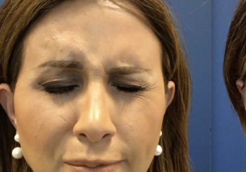 Can Facial Fillers Help Patients with Bell's Palsy?