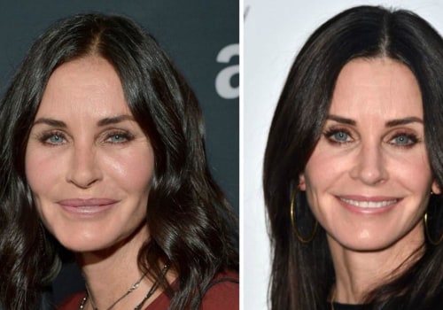 Everything You Need to Know About Dissolving Facial Fillers