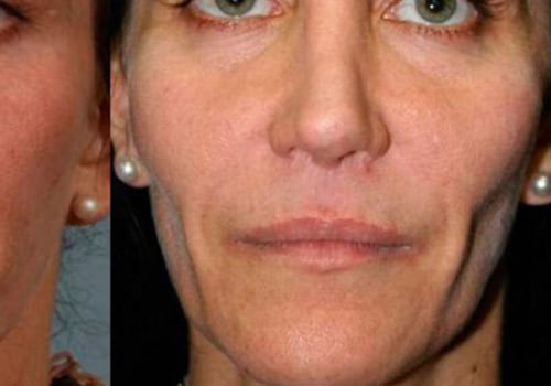 The Best Facial Fillers: A Comprehensive Guide