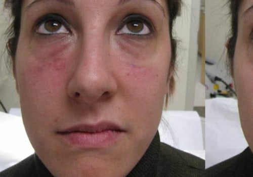 When to Get Facial Fillers: A Guide for Men and Women